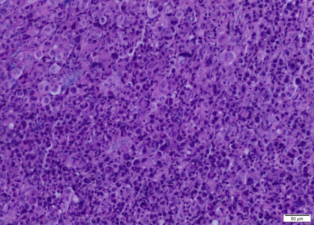 July: 53 years-old man with Non-Small Cell Lung Cancer